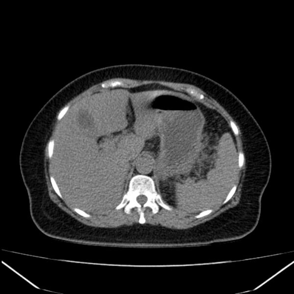 File:Acute pancreatitis - Balthazar C (Radiopaedia 26569-26714 Axial non-contrast 25).jpg