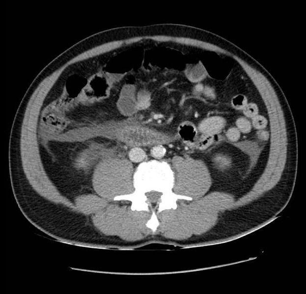 File:Acute pancreatitis - Balthazar E (Radiopaedia 23080-23110 Axial C+ portal venous phase 39).jpg