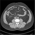 Acute pancreatitis - mild (Radiopaedia 27796-28033 Axial non-contrast 33).jpg