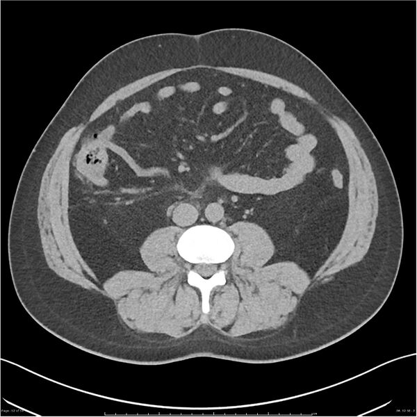 File:Acute pancreatitis - mild (Radiopaedia 27796-28033 Axial non-contrast 33).jpg