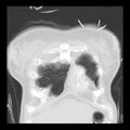 Acute pulmonary edema on CT (Radiopaedia 33582-34672 Coronal lung window 3).jpg