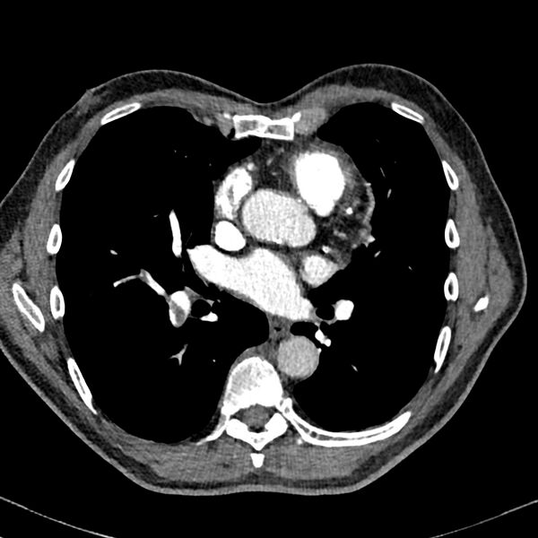 File:Acute pulmonary embolism (Radiopaedia 81677-95570 Axial C+ CTPA 61).jpg