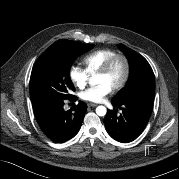 File:Acute pulmonary embolism with pulmonary infarct (Radiopaedia 73062-83768 Axial C+ CTPA 43).jpg
