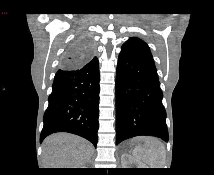 File:Acute right lung abscess (Radiopaedia 34806-36258 Coronal C+ arterial phase 13).jpg