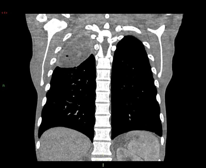 Acute right lung abscess (Radiopaedia 34806-36258 Coronal C+ arterial phase 13).jpg
