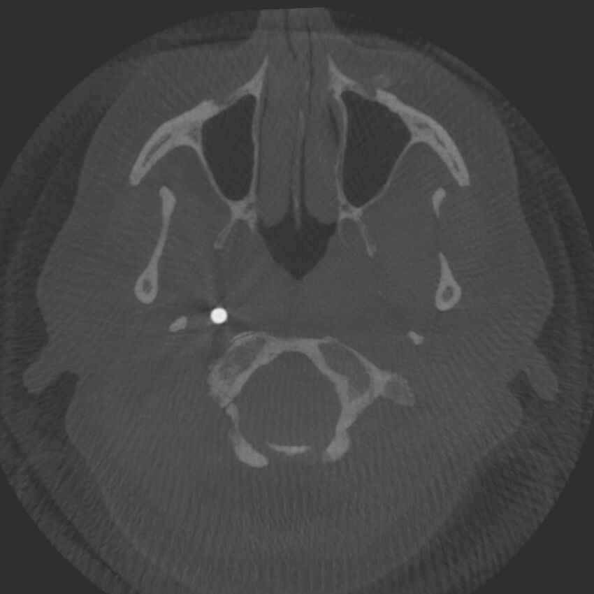 Acute subarachnoid hemorrhage and accessory anterior cerebral artery (Radiopaedia 69231-79010 Axial arterial - MIP 1).jpg