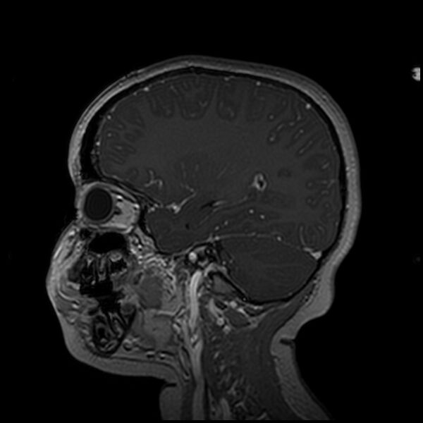 File:Adamantinomatous craniopharyngioma (Radiopaedia 77407-89529 H 81).jpg