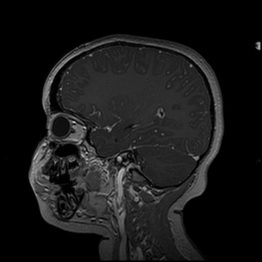 Adamantinomatous craniopharyngioma (Radiopaedia 77407-89529 H 81).jpg