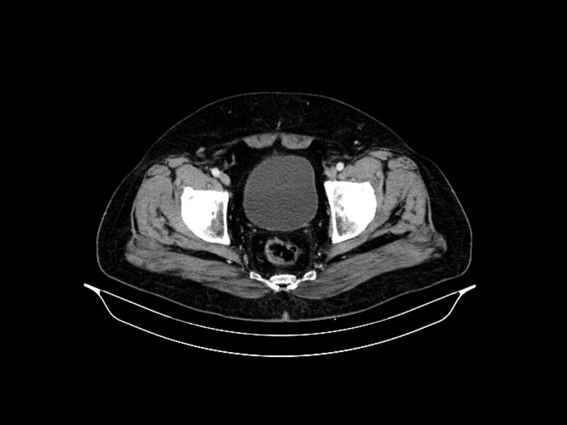 File:Adenocarcinoma of pancreas with hepatic metastasis (Radiopaedia 64332-73122 Axial C+ portal venous phase 92).jpg