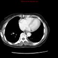 Adenocarcinoma of the colon (Radiopaedia 8191-9039 Axial liver window 4).jpg
