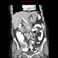 Adenocarcinoma of the colon (Radiopaedia 8191-9039 Coronal liver window 20).jpg