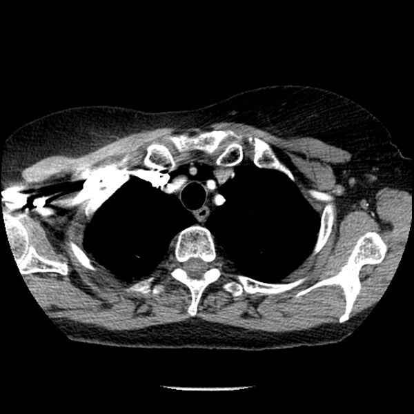 File:Adenocarcinoma of the lung (Radiopaedia 41015-43755 Axial C+ portal venous phase 17).jpg