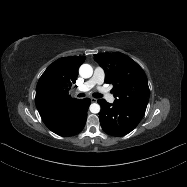 File:Adenocarcinoma of the lung (Radiopaedia 44205-47803 Axial C+ portal venous phase 38).jpg