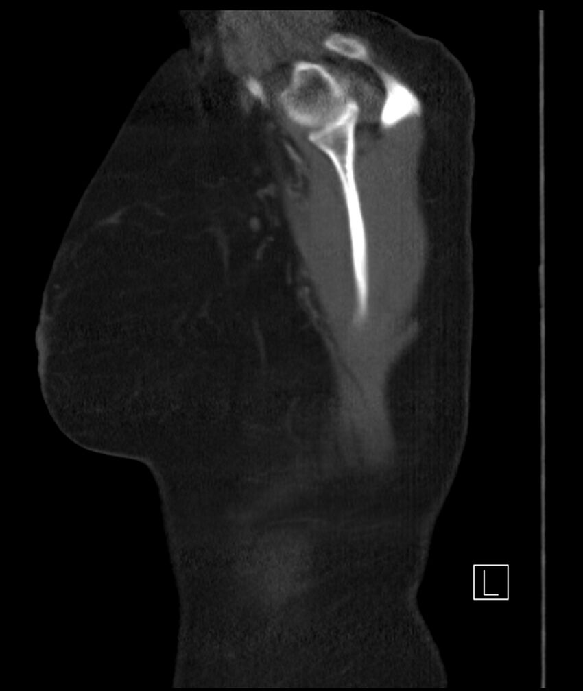 Adenocarcinoma of the lung (Radiopaedia 44205-47803 Sagittal C+ portal venous phase 1).jpg