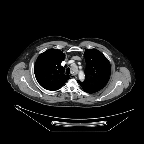 File:Adenocarcinoma of the lung (Radiopaedia 44876-48759 Axial C+ portal venous phase 21).jpg
