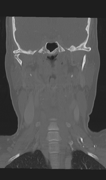 File:Adenoid cystic tumor of palate (Radiopaedia 46980-51518 Coronal bone window 36).png