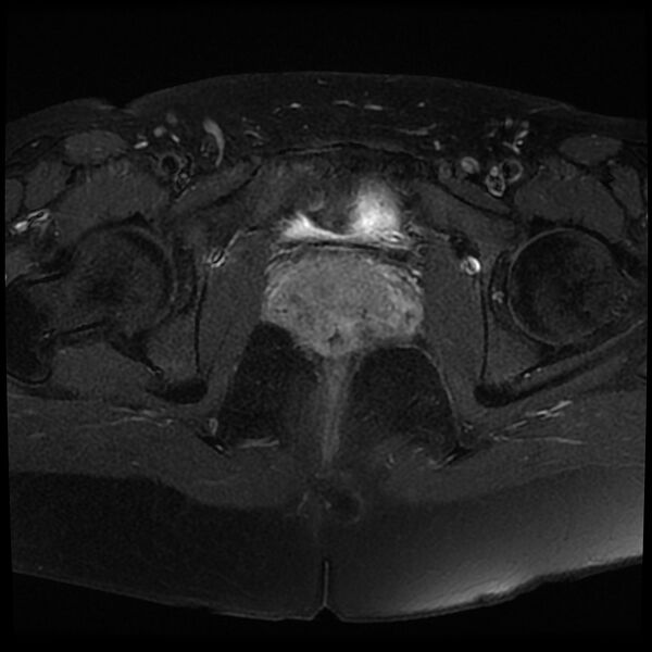File:Adenomyosis-scar endometriosis (Radiopaedia 65863-75022 Axial T1 C+ fat sat 21).jpg