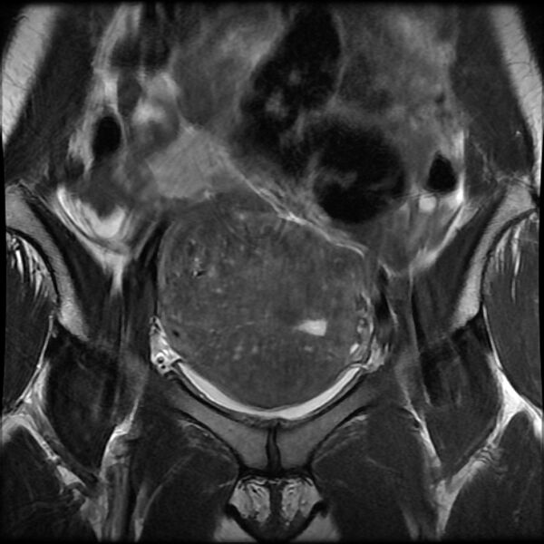 File:Adenomyosis on MRI (Radiopaedia 29328-29780 Coronal T2 12).jpg