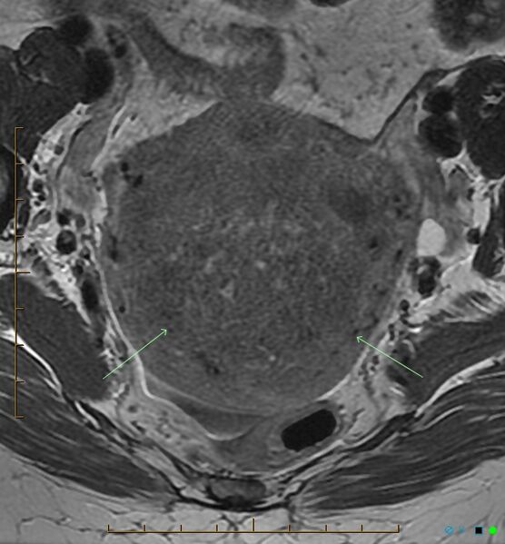 File:Adenomyosis uterus with hematometra (Radiopaedia 45779-50011 Axial T2 12).jpg