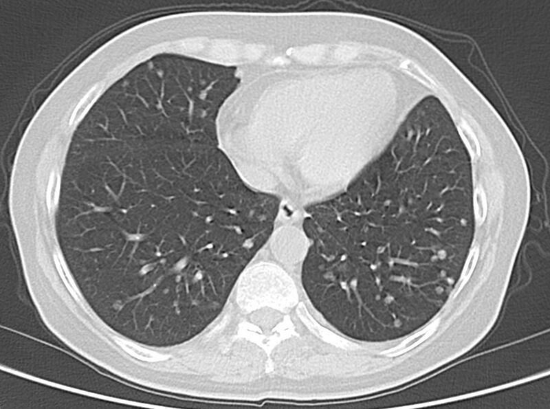 File:Adenosquamous lung carcinoma (Radiopaedia 22035-22030 lung window 44).jpg