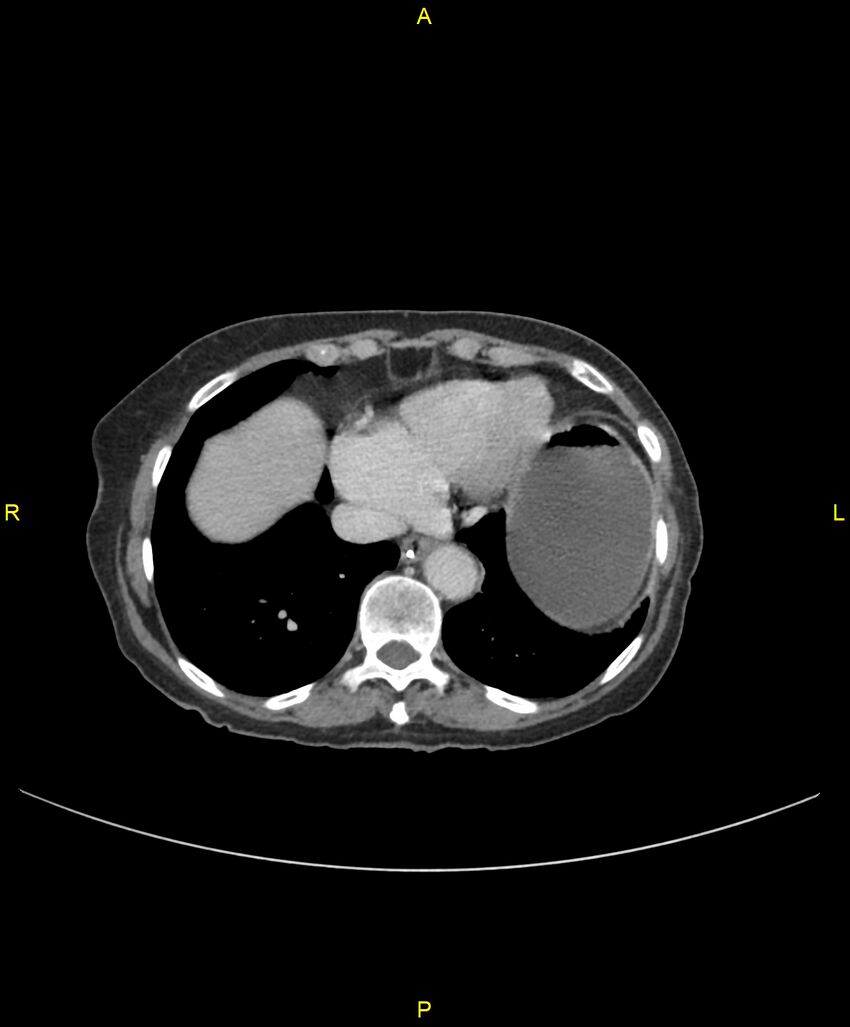 Adhesional small bowel obstruction (Radiopaedia 85402-101024 Axial C+ portal venous phase 22).jpg