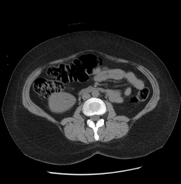 File:Adrenal cortical carcinoma with IVC invasion and thrombosis (Radiopaedia 34307-35597 Axial non-contrast 33).jpg
