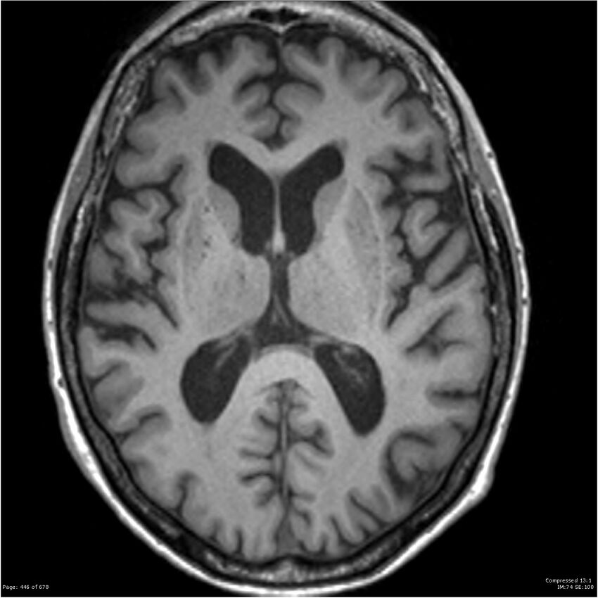 Alzheimer disease (Radiopaedia 22196-22226 Axial T1 36).jpg