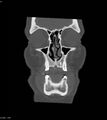 Ameloblastoma (Radiopaedia 18115-17901 Axial bone window 17).jpg