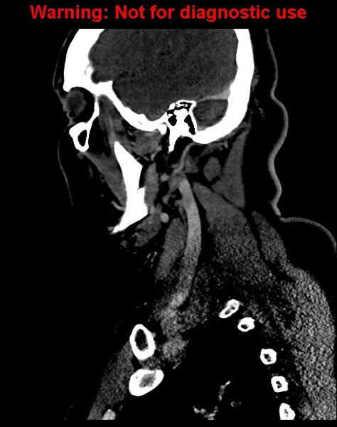 File:Ameloblastoma (Radiopaedia 33126-34164 F 52).jpg