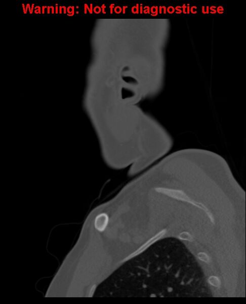 File:Ameloblastoma (Radiopaedia 33126-34164 Sagittal bone window 65).jpg