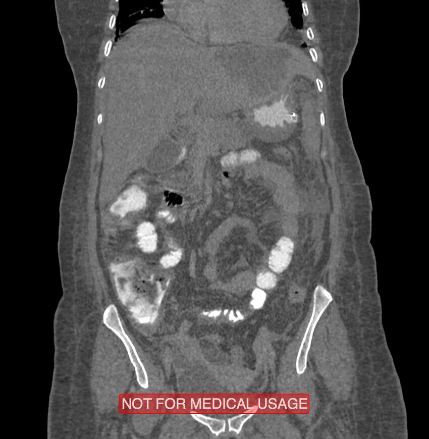 Amoebic enterocolitis with liver abscess (Radiopaedia 35100-36609 B 76).jpg