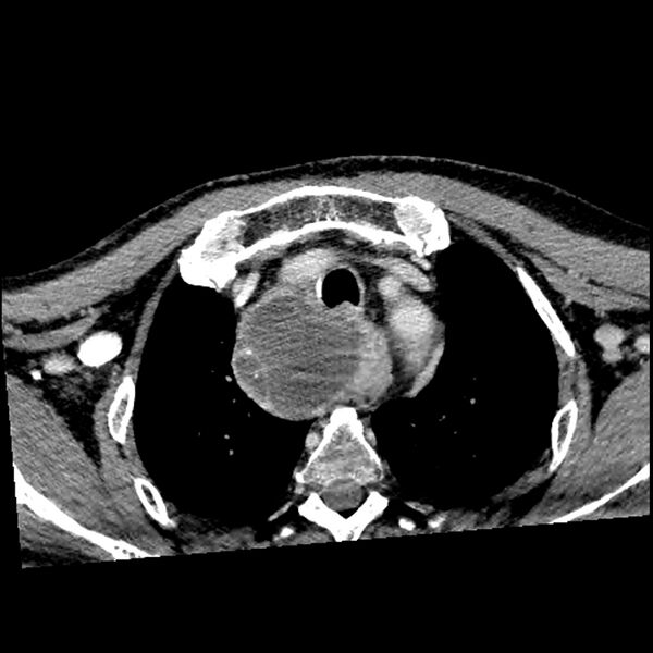 File:Anaplastic thyroid carcinoma (Radiopaedia 79087-92034 B 16).jpg