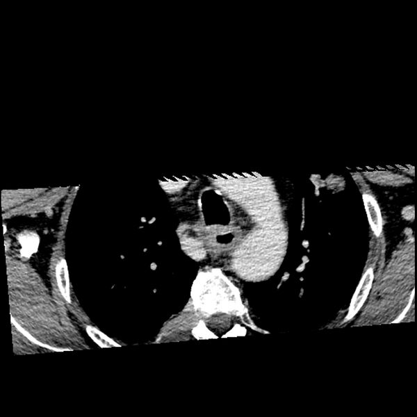 File:Anaplastic thyroid carcinoma (Radiopaedia 79087-92034 B 4).jpg