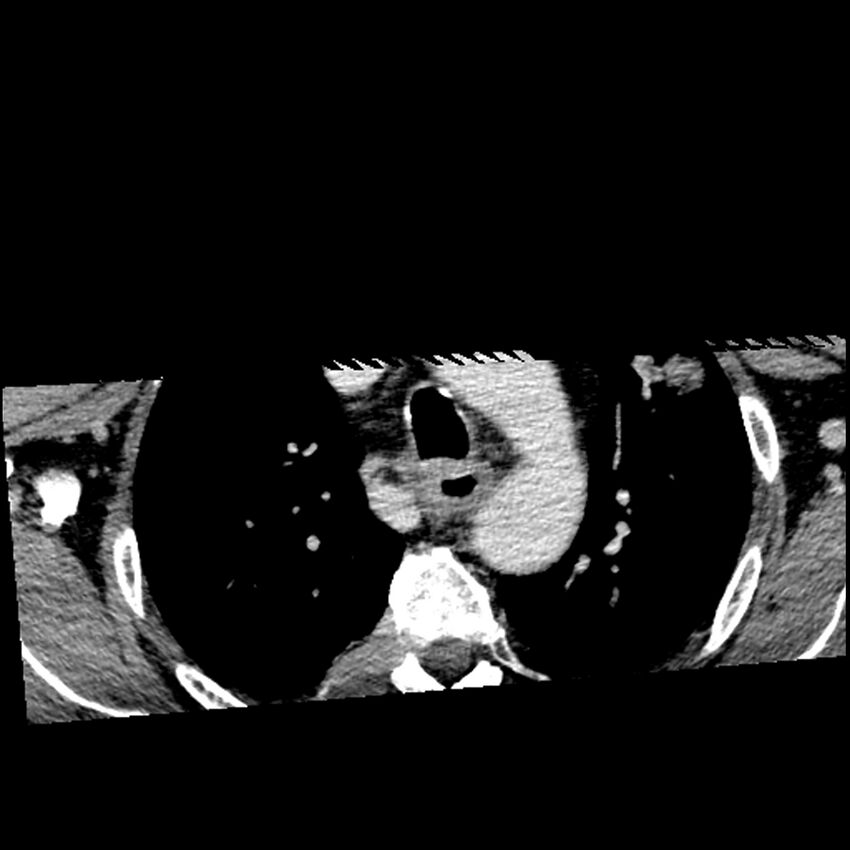 Anaplastic thyroid carcinoma (Radiopaedia 79087-92034 B 4).jpg