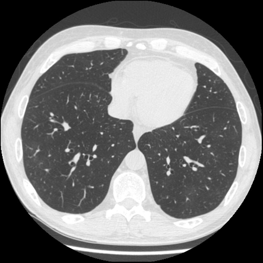 Angioinvasive aspergillosis (Radiopaedia 43957-47466 Axial lung window 49).jpg