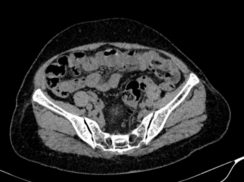 Angiomyolipoma (Radiopaedia 83682-98824 Axial non-contrast 49).jpg