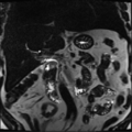 Annular pancreas (Radiopaedia 38292-40320 Coronal T2 14).png
