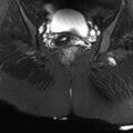 Ano-vaginal fistula (Radiopaedia 29765-30284 Coronal STIR 17).jpg