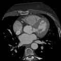 Anomalous origin of left circumflex artery from right coronary sinus (Radiopaedia 72563-83117 B 64).jpg