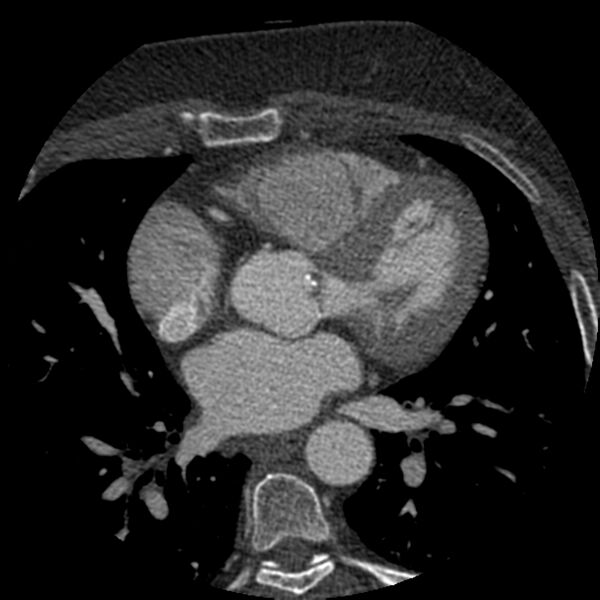 File:Anomalous origin of left circumflex artery from right coronary sinus (Radiopaedia 72563-83117 B 64).jpg