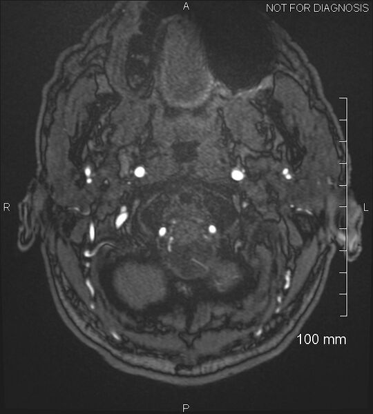File:Anterior cerebral artery aneurysm (Radiopaedia 80683-94127 Axial MRA 3).jpg
