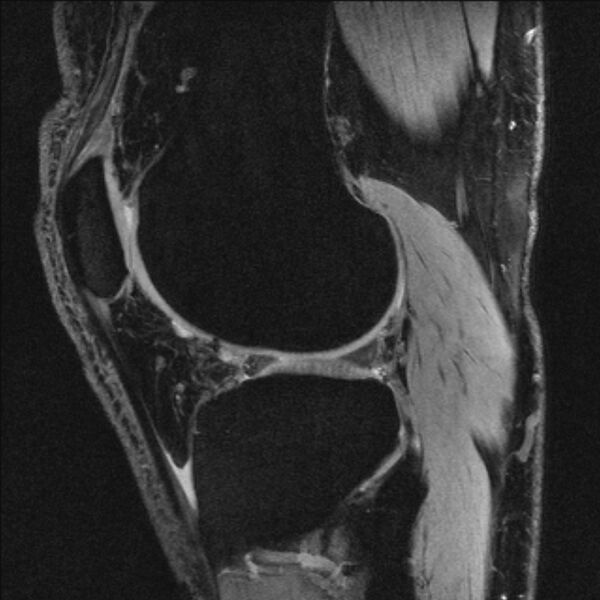 File:Anterior cruciate ligament mucoid degeneration (Radiopaedia 68400-77933 Sagittal 18).jpg