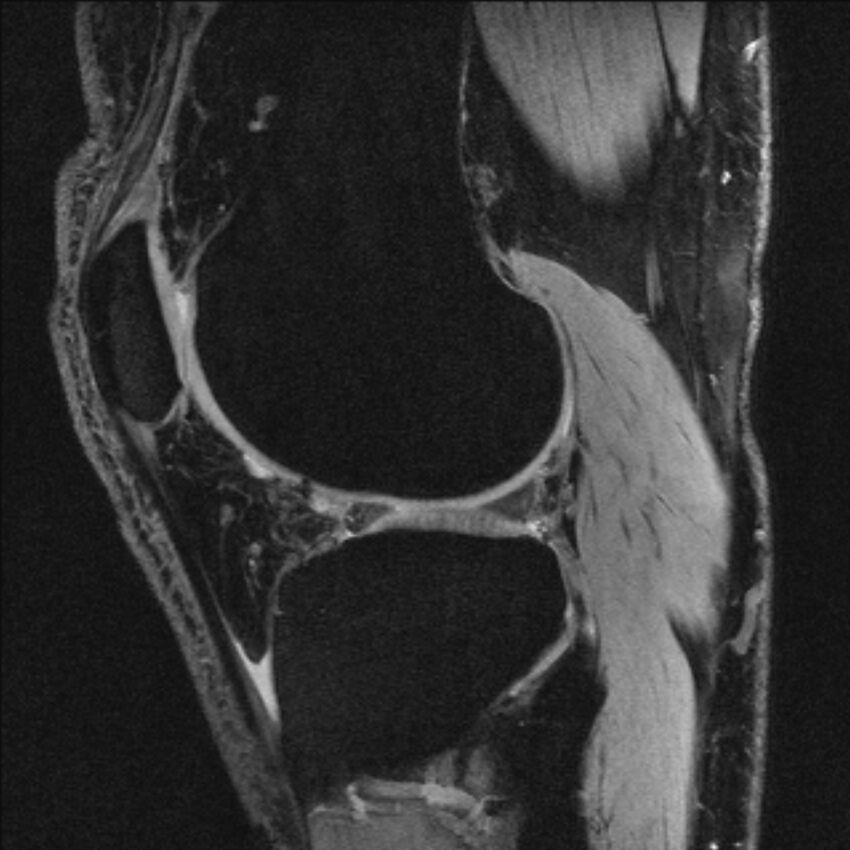Anterior cruciate ligament mucoid degeneration (Radiopaedia 68400-77933 Sagittal 18).jpg