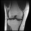 Anterior cruciate ligament tear with posteromedial corner injury, bucket-handle meniscal tear and chondral delamination (Radiopaedia 75501-86744 Coronal T1 13).jpg