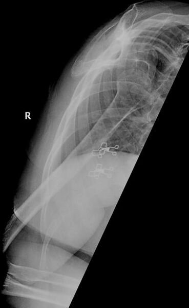 File:Anterior glenohumeral joint dislocation (Radiopaedia 10370-10892 Lateral 1).jpg