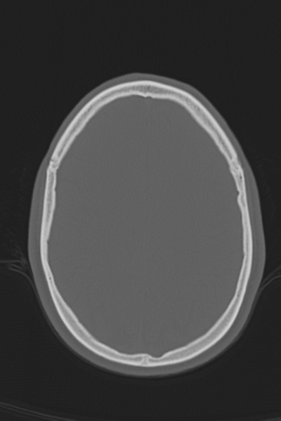 File:Anterior nasal spine fracture (Radiopaedia 46138-50494 Axial bone window 20).png