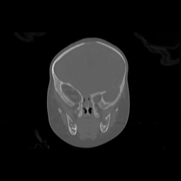 File:Anterior plagiocephaly (Radiopaedia 71836-82273 Coronal bone window 8).jpg