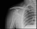 Anterior shoulder dislocation (Radiopaedia 10077).jpg