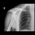 Anterior shoulder dislocation (Radiopaedia 86730).JPEG