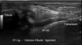 Anterior talofibular ligament injury (Radiopaedia 59447).jpg